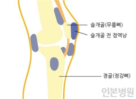 무릎 점액낭염