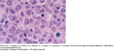미만성 거대 b 세포 림프종