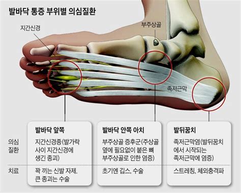 발 바깥 쪽 뼈 통증 - 칼럼 찌릿~!한 발바닥 통증, 족저근막염
