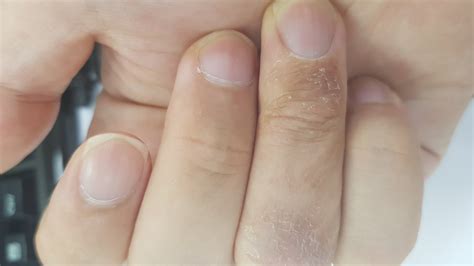 손가락 마디 가려움 - 피부 가려움증 임신소양증 수포 및