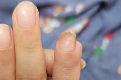 손가락 절단 손톱길이 전문의상담 예손병원 - 손톱 길이