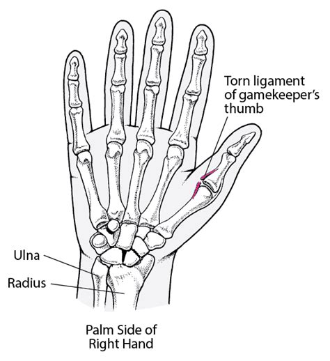 손가락 탈구 부상 및 중독 Msd 매뉴얼 일반인용 - et 손가락 - U2X