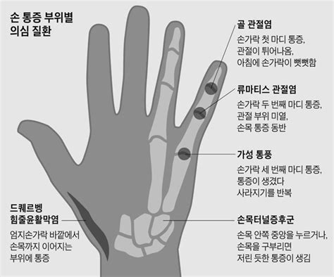 손가락 통증, 손가락 관절염 류마티스 으로 발전할 수