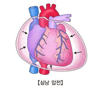 심낭 압전 질환백과 의료정보 서울아산병원 - 심장 압전