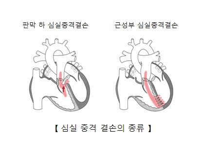 심실 중격 결손 질환백과 의료정보 건강정보 서울아산병원