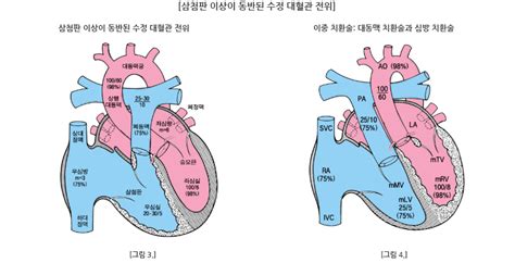 심장병 종류