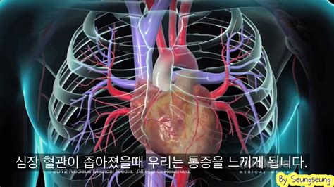 심혈관 조영술