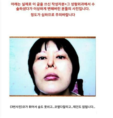 싸이코 성형외과 사건 성예사 - 사이코 패스 성형 의사