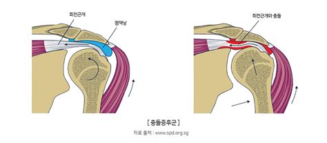 어깨 충돌 증후군 테스트