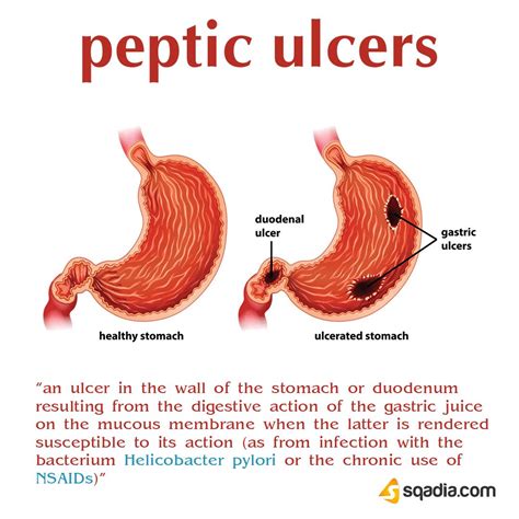 에서의 의미 - peptic ulcer 뜻