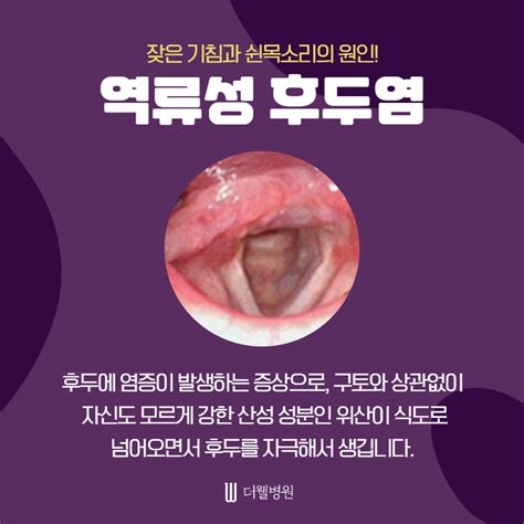 역류성 후두염
