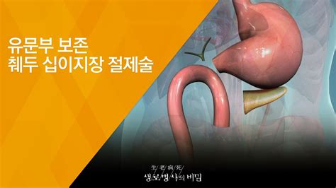 유문보존 췌십이지장 절제술 수술과정 - pppd 수술