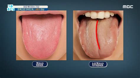 입속에 생기는 암 이 증상 나타나면 의심 - 혀 밑