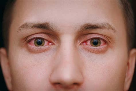자주 충혈되는 눈, 간기능 저하 때문일 수도 당신의 건강 - 눈 충혈 지속