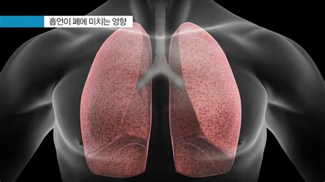 진료질환정보 폐기종 emphysema 서울대학교어린이병원 - 폐기종 ct