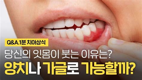 치은퇴축으로 잇몸이 내려앉았을 때 치료하는 방법 광화문잇몸