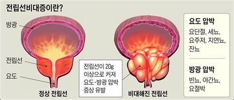 클리 비대증nbi