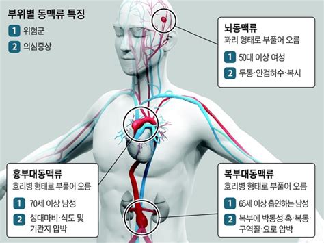 팔, 다리, 심장 동맥의 동맥류 심장 및 혈관 장애 MSD 매뉴얼 일반인용