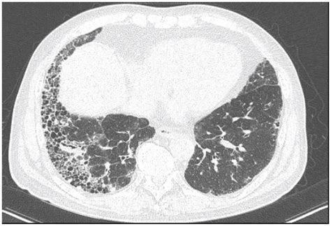 폐기종을 동반한 특발성 폐섬유화증 - 폐기종 ct - Hrj