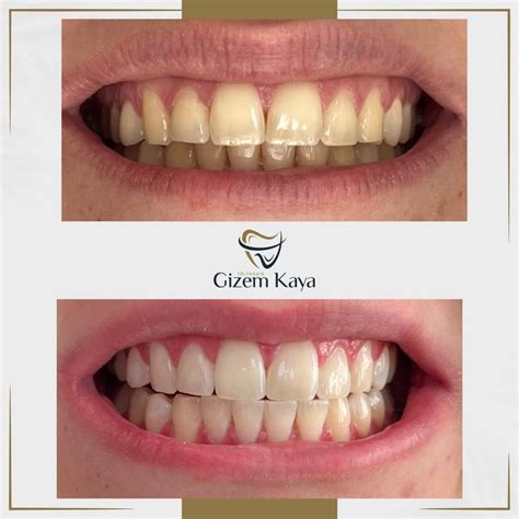 퐒퐄퐌퐏퐀퐓퐈̇ 퐕퐄퐓퐄퐑퐈̇퐍퐄퐑 퐊퐋퐈̇퐍퐈̇퐆̆퐈̇ on Instagram: " Diş . 