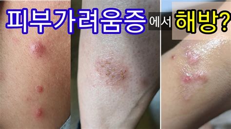 피부염 개요 피부 질환 MSD 매뉴얼 일반인용 - 가려운 피부병