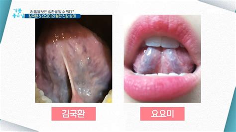 혀밑염증 건강