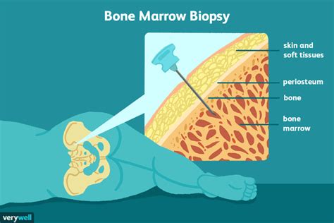 A bone marrow or liver biopsy may be performed if these are enlarged