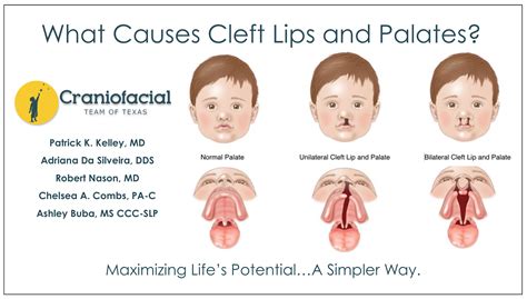  A cleft palate can affect both the hard and soft palate separately and together and may cause a cleft lip