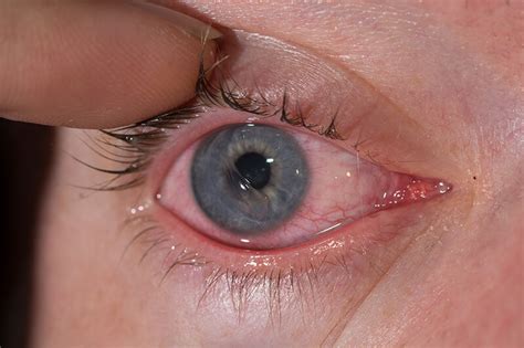 A damaged cornea is painful and should be treated immediately