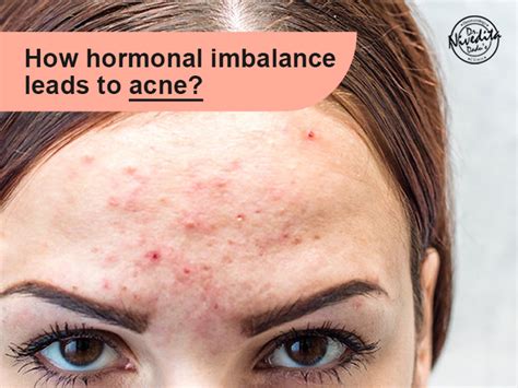  A hormonal imbalance can also be the cause of pimples