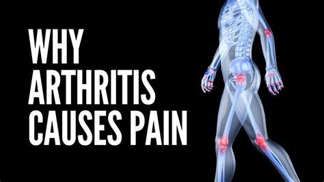  A lot of it is arthritis and things like that