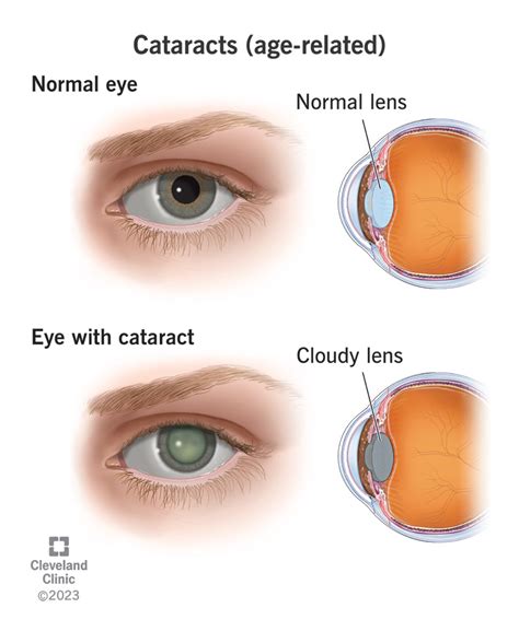  A range of eye problems, including cataracts there is screening for this