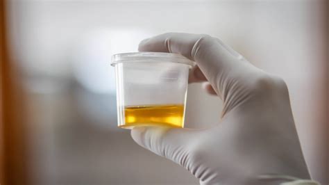  A urine sample can usually be taken at any time of day, but you may be specifically asked for a first-morning sample