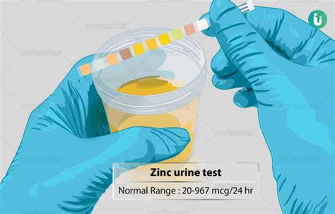  Also, no suitable method could be established to detect zinc in urine samples