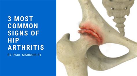  And, like arthritis, hip dysplasia is a condition that involves joint pain and inflammation
