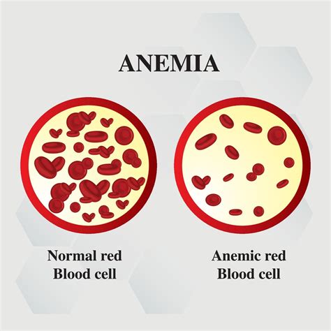  Anemia: The presence of heartworms can lead to a depletion of red blood cells, resulting in anemia