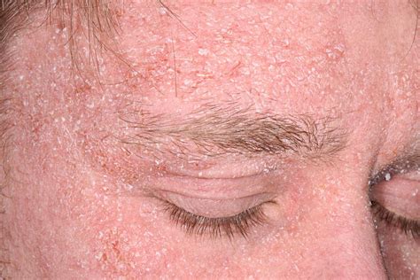  Another common skin disease called seborrhea can cause dry, flaky skin or greasy, oily skin