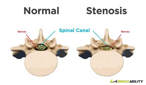  Another example is cranial thoracic vertebral canal stenosis CTVC , where the vertebrae are malformed and squeeze the spinal cord