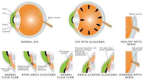  As a result, it can slow the progression of glaucoma
