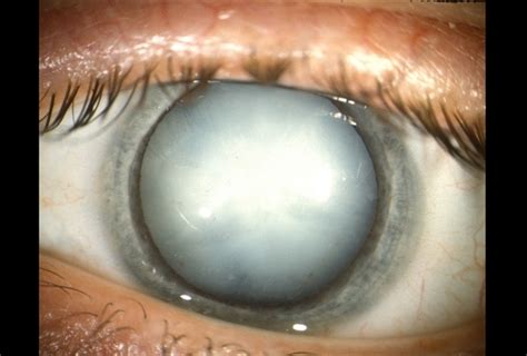  As the cataract worsens from mature to hypermature which can take months or even years , it causes a wrinkling of the lens, and the contents become solidified and shrunken