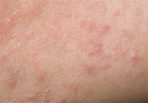  At the beginning of dermatitis, you will see irritated red skin that will later progress to scaling, scabbing, and even pustules