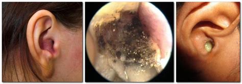  Bacteria, yeast, and parasites live in the ear canal