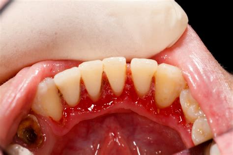  Bacteria can enter the blood through inflamed gums and exposed blood vessels in broken teeth