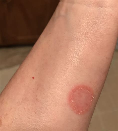  Being highly contagious, ringworm is a common occurrence, as well
