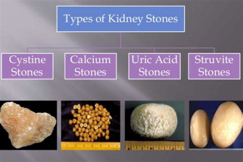  Bladder or Kidney Stones There are a few different types of stones that can form in the kidney or in the bladder, and French Bulldogs are more likely to develop them than other breeds