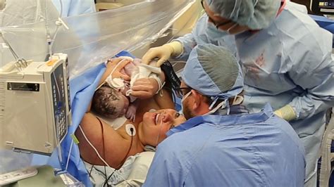  Caesarean deliveries are commonly needed