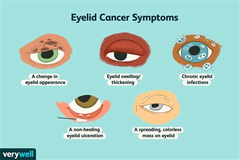  Cancer of the eye