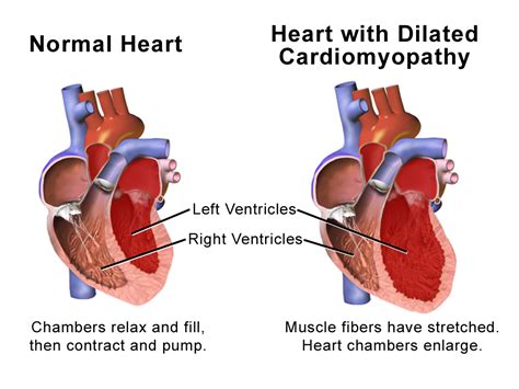  Cardiomyopathy — this is an enlarged heart with poor function