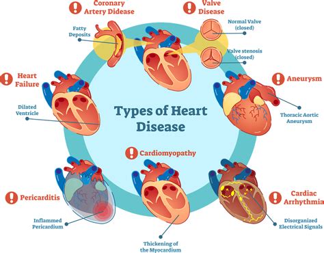  Cardiomyopathy can also be caused by a dietary deficiency