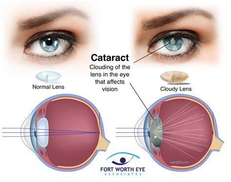  Cataracts, a cloudy lens, can cause blindness, but surgery can correct it